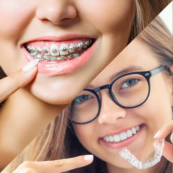 Alineadores Invisalign