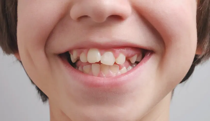 APIÑAMIENTO DENTAL EN NIÑOS